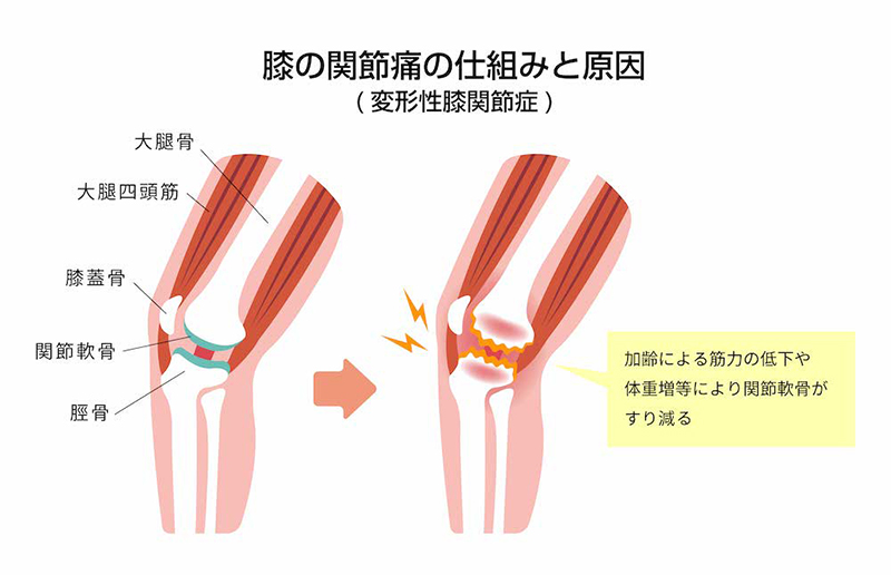 膝の関節痛の仕組みと原因